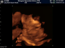 Vivian Sonograms